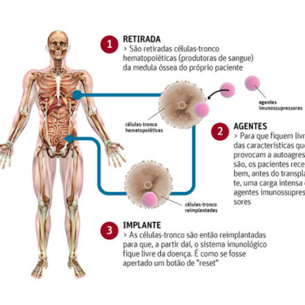 Brasil tem 1º caso de sucesso em terapia celular contra Doença de Crohn