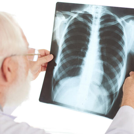 IGRA para diagnóstico da tuberculose latente